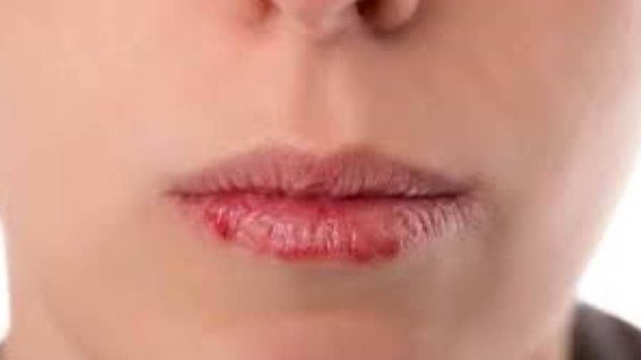 تحذير من مشاكل الشفاه.. فما هي الأسباب؟