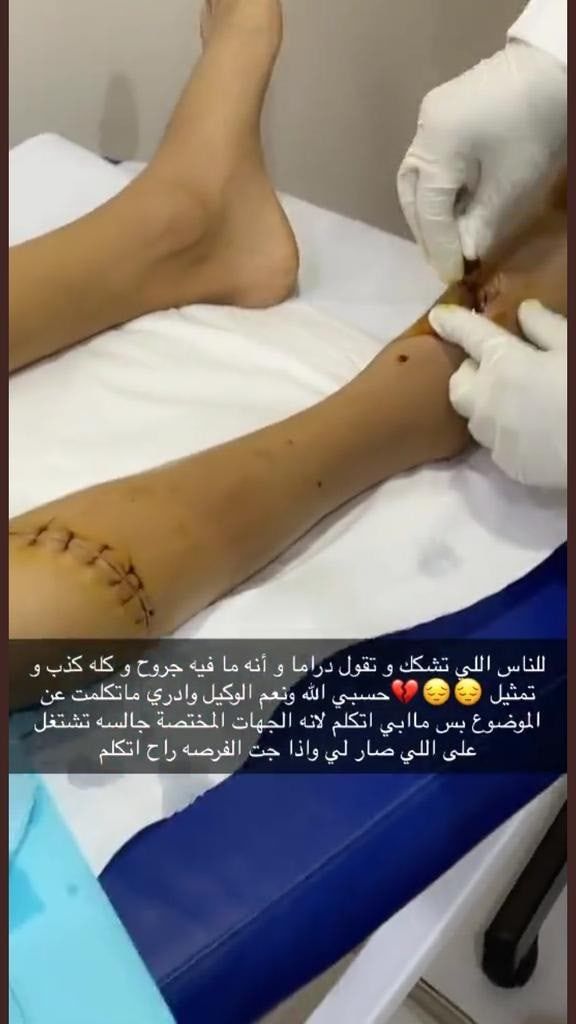 المودل السعودي هيما يكشف عن تعرضه لضرب مبرّح