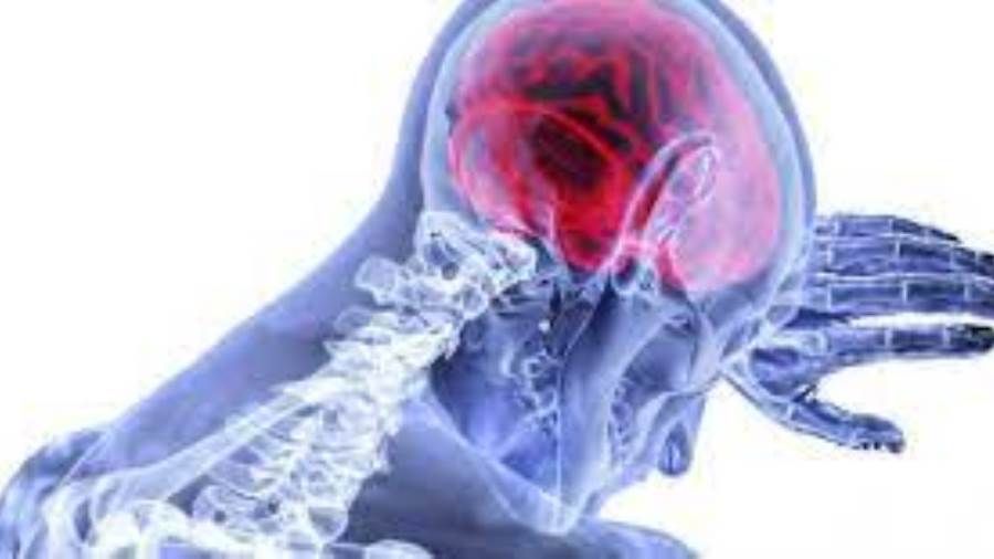 أبرز عوامل الإصابة بالسكتة الدماغية