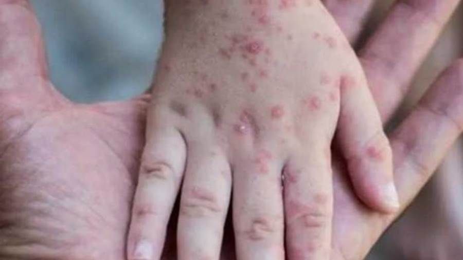 شركة موديرنا تختبر لقاحا محتملا للوقاية من جدري القرود