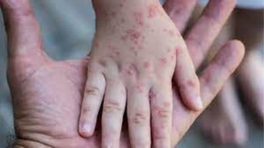 دراسة: بعض الأدوية تختصر فترة العدوى بجدري القرود