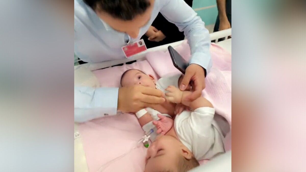 السعودية.. بدء عملية فصل التوأمين السياميين اليمنيين "مودة ورحمة"