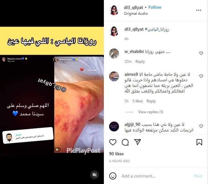 روزانا اليامي تكشف عن إصابتها بمرض جلدي