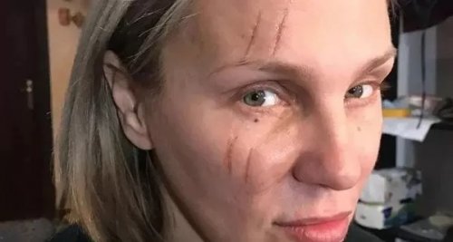 ظهور مفزع لشيرين رضا ووجهها مليء بالكدمات والحروق.. ماذا حدث لوجهها الجميل؟! تشوهه مرعب ومخيف والمفاجأة من الفاعل...شوف دلوقتي