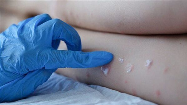 الصحة العالمية تصدر تحذيرا من جدري القردة