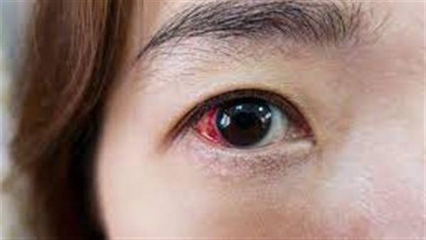 ما هي أسباب وأعراض المرض المسبب للعمى؟