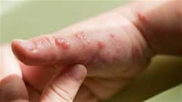 وزارة الصحة الكوبية تعلن تسجيل أول حالة من مرض جدري القردة في البلاد