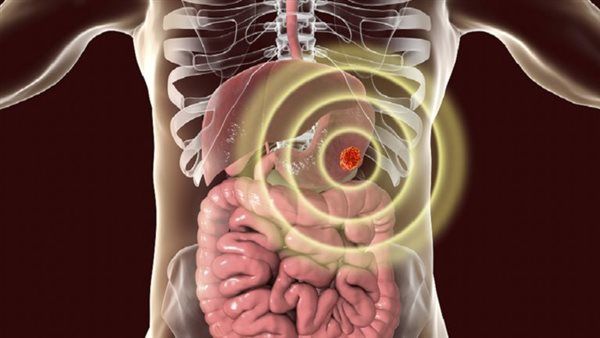 ست علامات تحذيرية لسرطان المعدة!
