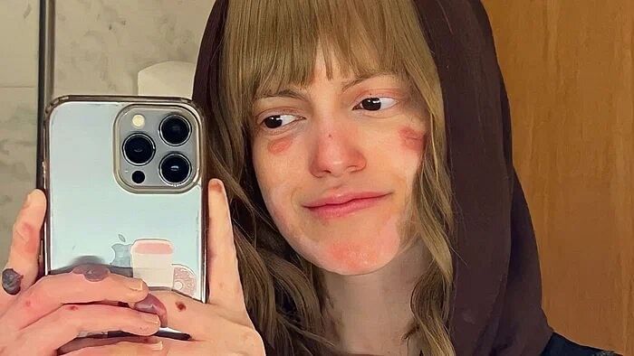 شابة سعودية تتحدى إصابتها بمرض نادر وتواجه التنمر