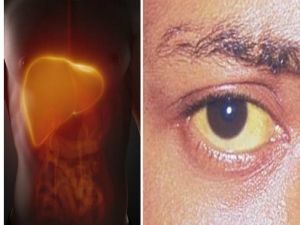 أخصائي يكشف سبب اصفرار بياض العين: أنت مصاب بمرض خطير وهذا هو العلاج