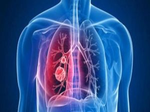 أعشاب طبيعية لتنظيف الرئتين من السموم بشكل فعال خصوصاً للمدخنين..(طريقة التحضير)