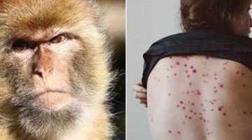 الجدرى ينتشر في أمريكا.. الإصابات تتضاعف هذا العام وتنتشر في كافة الولايات ومطالب بتطعيم الفئات الأكثر تتضرر بالإصابة