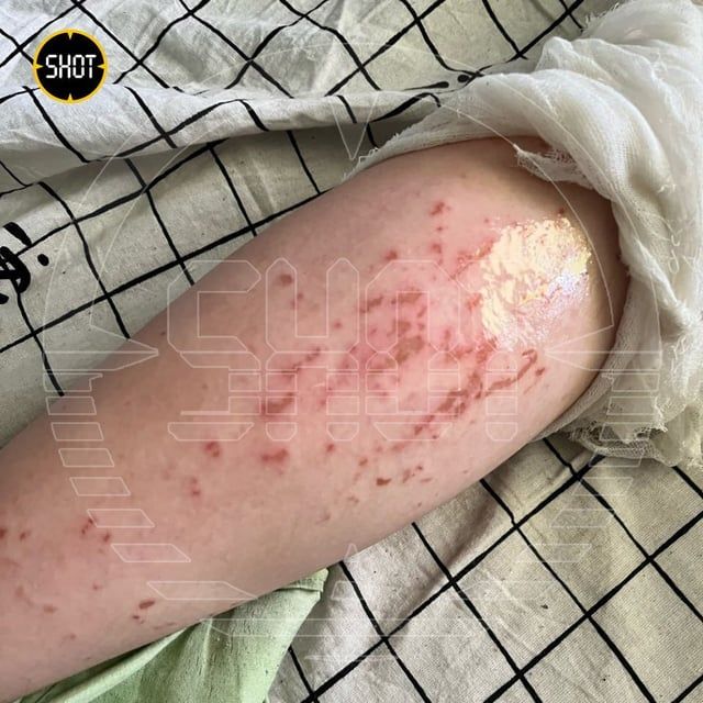 مهندس يرشق النساء بسائل حارق في ضواحي موسكو (صور)