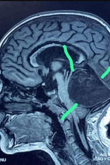 كادت أن تقتلها.. اكتشاف خصلة شعر طويلة في دماغ طفلة (صور)