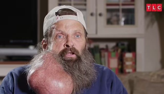 ورم يمنع رجل من الأكل والاستحمام.. بدأ بثرة وأصبح بحجم بطيخة (صور)