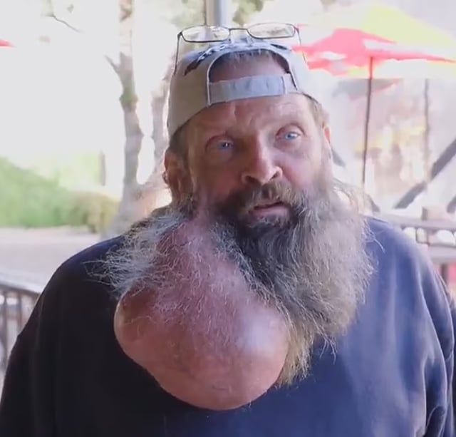 ورم يمنع رجل من الأكل والاستحمام.. بدأ بثرة وأصبح بحجم بطيخة (صور)