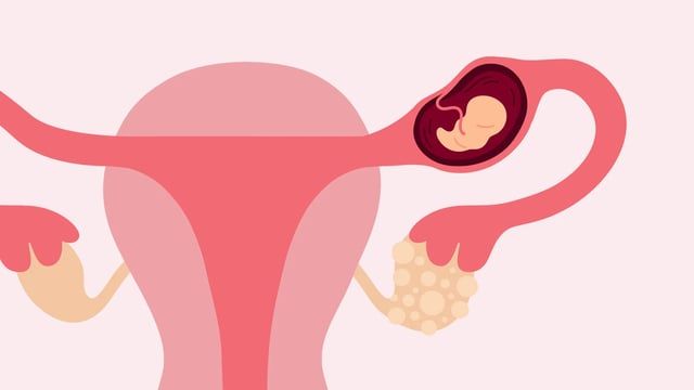 الحمل خارج الرحم.. ما أعراضه؟