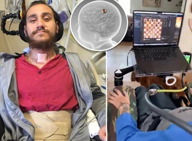 بعد زرعها في دماغ مريض.. شريحة إيلون ماسك تواجه مشكلة