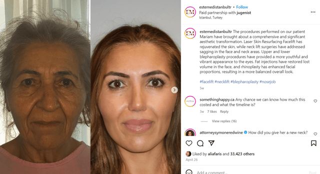 جراحات تجميل صادمة في تركيا.. والمرضى أصغر بـ30 عامًا (صور)