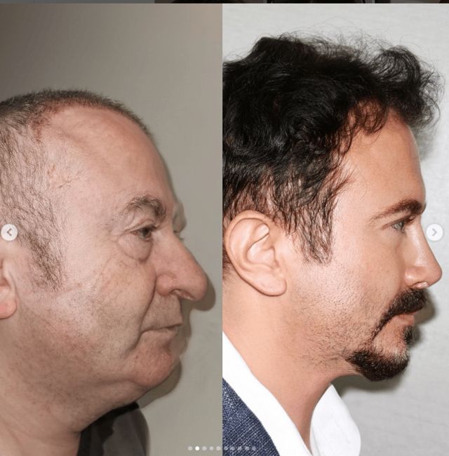 جراحات تجميل صادمة في تركيا.. والمرضى أصغر بـ30 عامًا (صور)