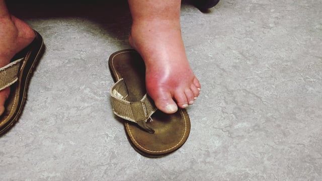 5 علامات تنذر بوجود مشكلات في الكبد