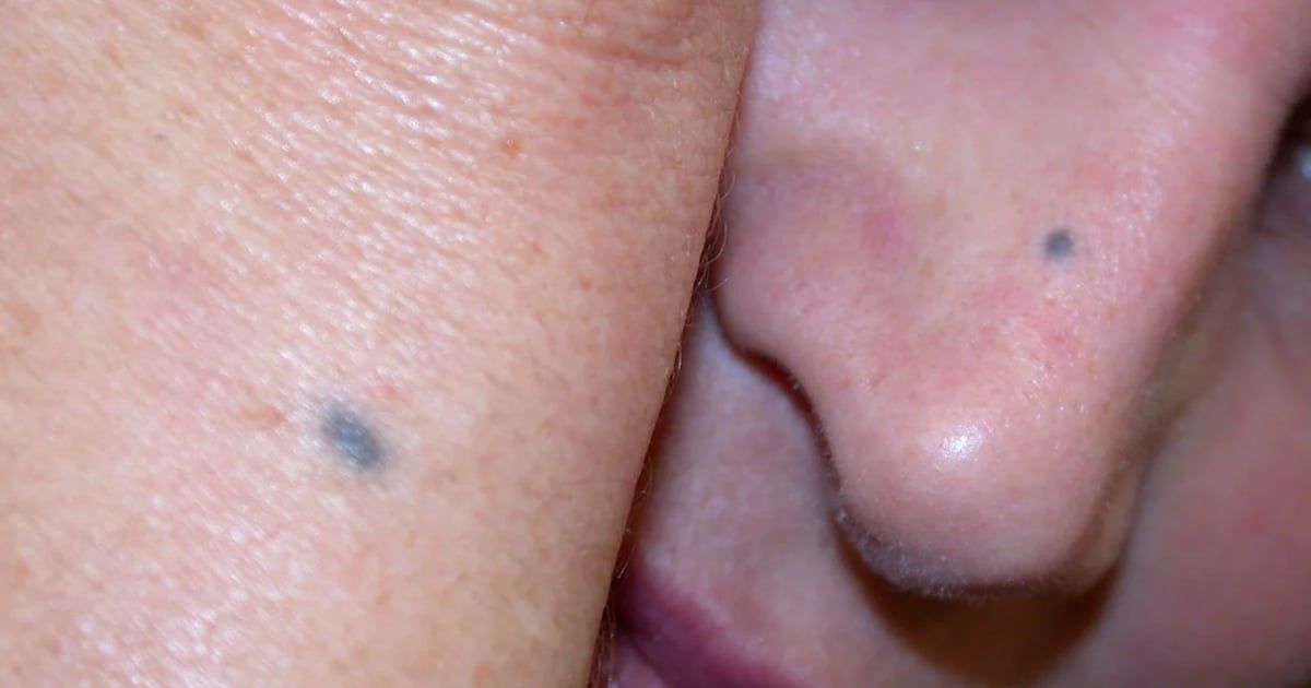 احذر.. ظهور بقع زرقاء على الجلد قد يكون مؤشرًا خطيرًا