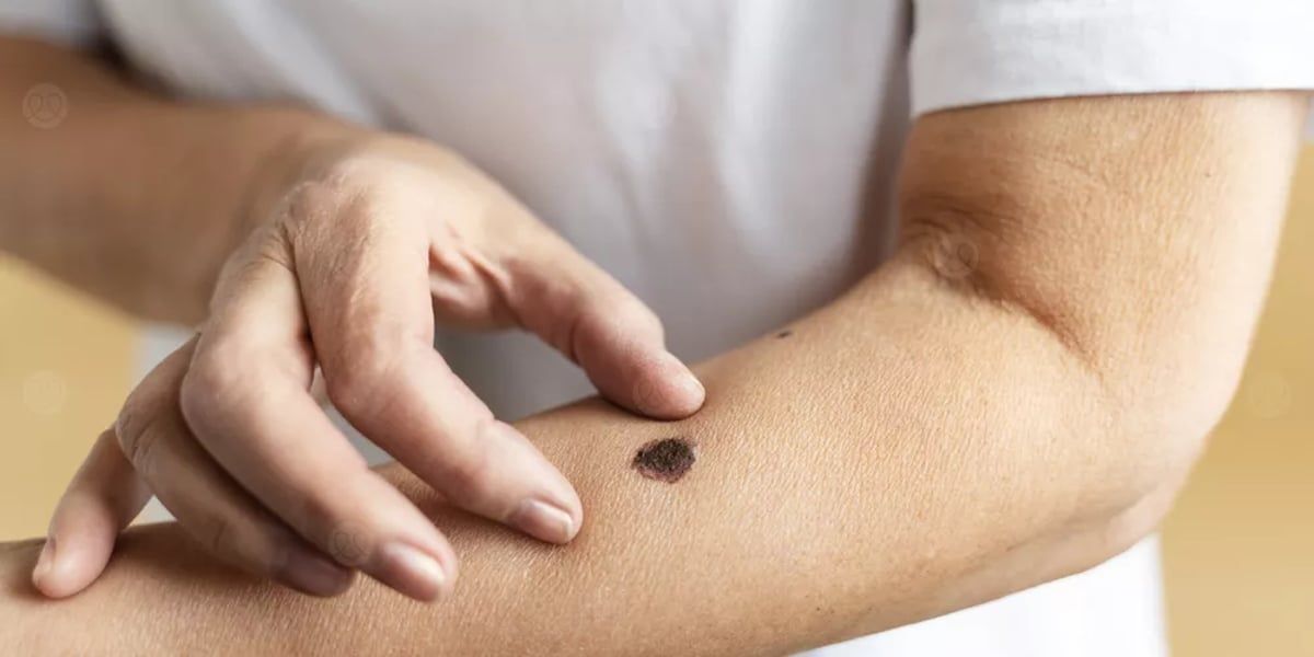 تشخيص سرطان الجلد أصبح أسهل بفضل الذكاء الاصطناعي