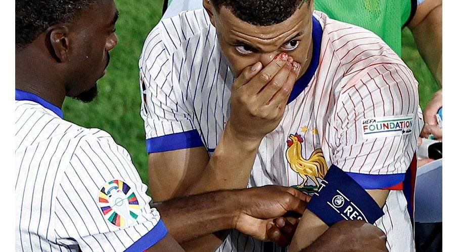 بعد تعرضه لكسر في الأنف.. هل يشارك مبابي في مواجهة فرنسا وهولندا؟