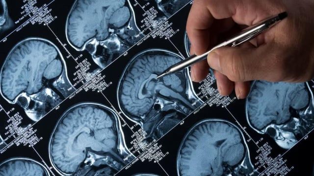 الذكاء الاصطناعي يحلل الكلام للتنبؤ بمرض الزهايمر