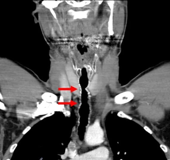 بحالة نادرة.. نمو شعر في حلق مدخن شره (صور)