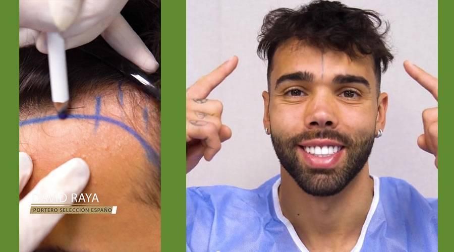 حارس أرسنال يخضع لعملية زرع شعر