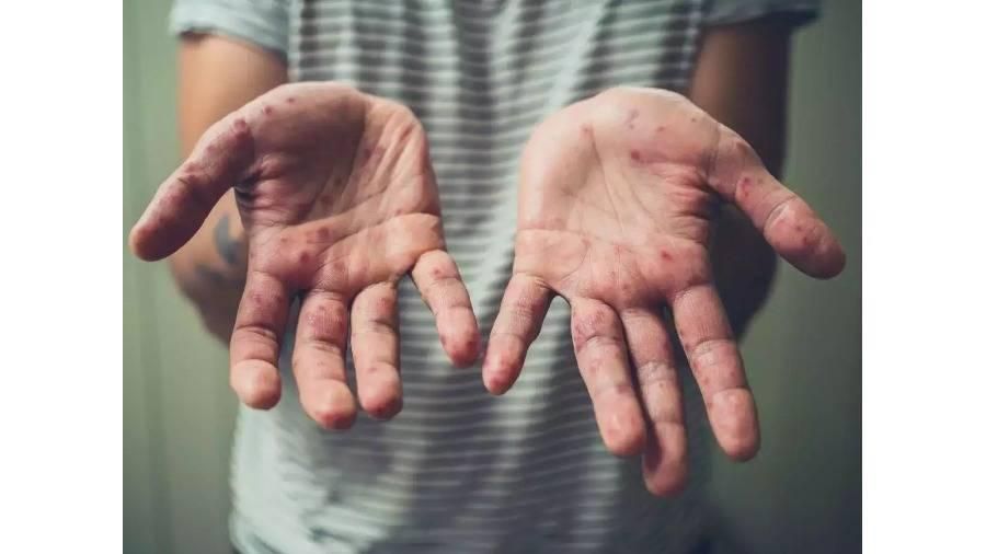 «الصحة العالمية» توصي بالتطعيم في مناطق تفشّي «جدري القرود»