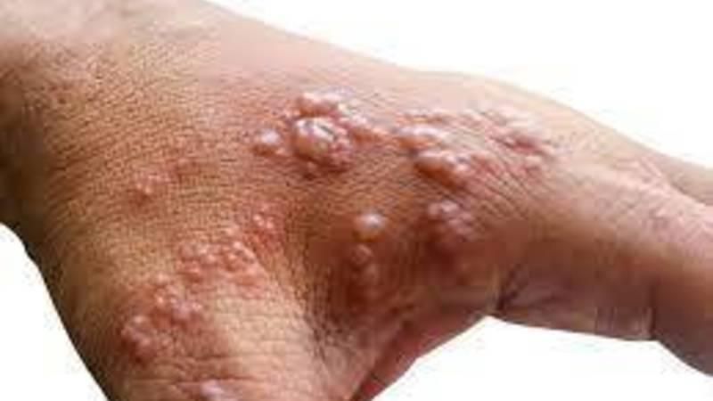 تايلاند: اكتشاف إصابة أوروبي قادم من إفريقيا بـ«جدري القردة»