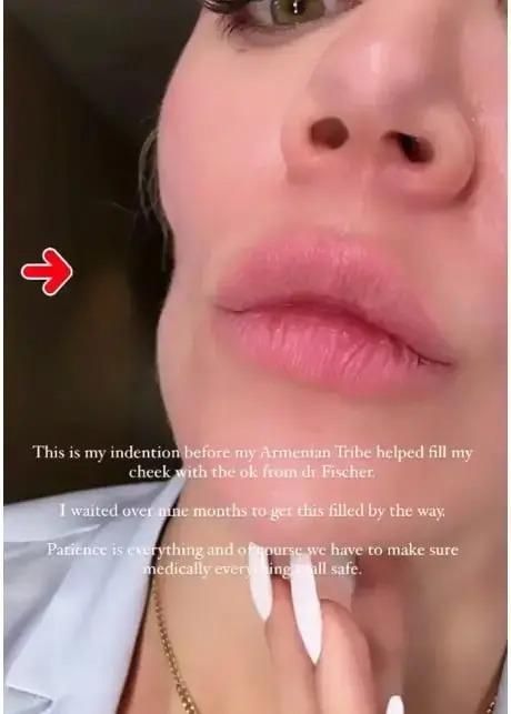 بالصور: “حفرة واضحة”.. شاهدوا كيف أصبح وجه كلوي كارداشيان بعد إصابتها بسرطان الجلد