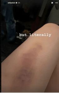 تعثرت وسقطت: نجمة تتعرّض لموقف محرج على المسرح.. وصورة تكشف عن حجم إصابتها