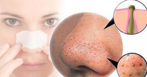 تخلصي من الرؤوس السوداء نهائيًا بوصفات طبيعية وآمنة