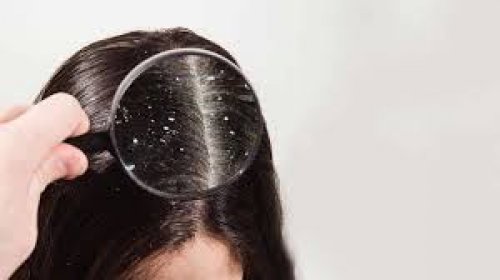 كيفية التخلص من القشرة نهائيا؟ .. تعرف على أفضل الوصفات الطبيعية تجعلك تحل المشكلة من جذورها