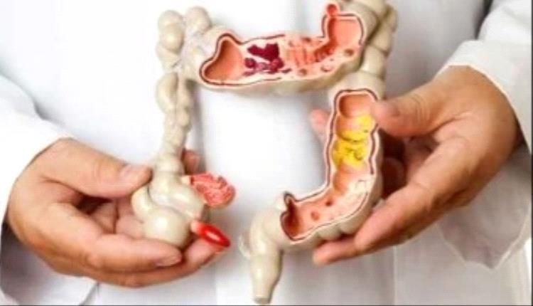 متلازمة القولون العصبي.. اعرف الأعراض ونصائح العلاج