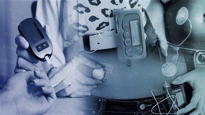 طفرة جديدة في تطوير البنكرياس الاصطناعي لعلاج السكري من النوع الأول - الخليج الان