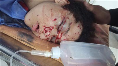 فتاة تصاب بطلق خرطوش في وجهها خلال حفل خطوبة في السنبلاوين - الخليج الان