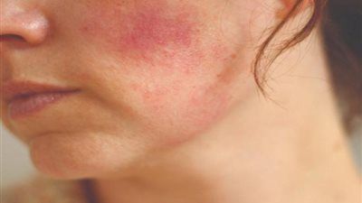 فصل الصيف.. الطرق الفعالة للتعامل مع التهابات البشرة بعد التعرض لأشعة الشمس - الخليج الان