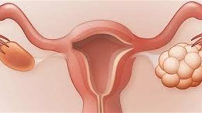 هل تعانين من تكيس المبيض؟ 10 إشارات لا يجب تجاهلها - الخليج الان