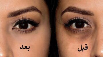عينيكي هترتاح.. طرق إزالة الهالات السوداء تحت العين طبيعية جدا وسهلة وهتدي نتيجة سريعة