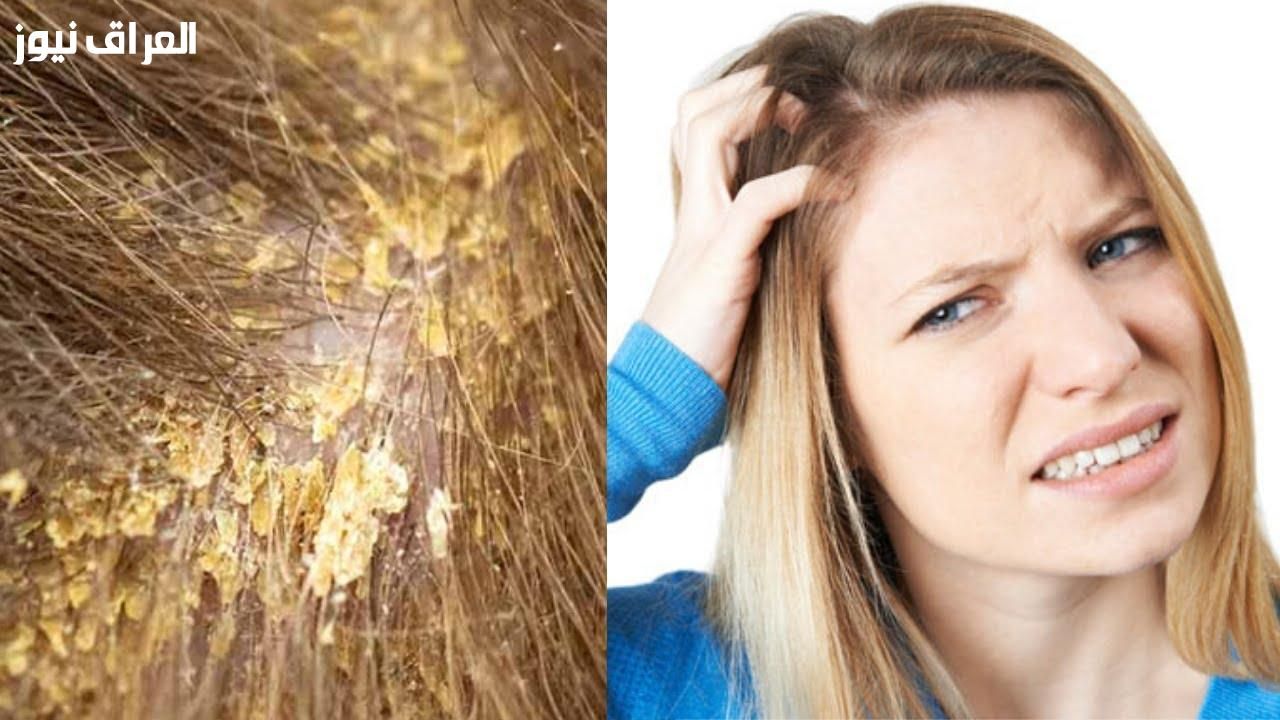 قشرة شعرك هتختفي.. أفضل طرق التخلص من قشرة الشعر طبيعية جدا وسهلة وهتديكي نتيجة فورية