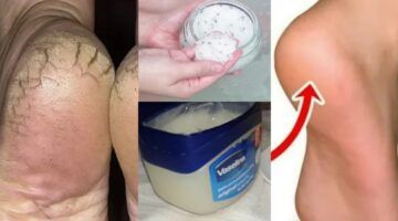 من أول مرة هتشوفي الفرق خلطة طبيعية لتشققات القدمين فعالة جدًا