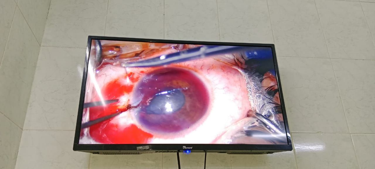 إنقاذ بصر طفل بعد جرح قطعي نافذ وانفجار بمقلة العين بمستشفى طب وجراحة العيون بالزقازيق - الخليج الان
