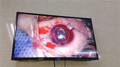 إنقاذ بصر طفل بعد جرح قطعي نافذ وانفجار بمقلة العين بمستشفى طب وجراحة العيون بالزقازيق - الخليج الان