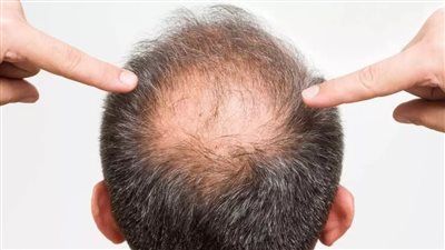 اكتشاف دواء جديد يعالج الصلع خلال شهرين - الخليج الان