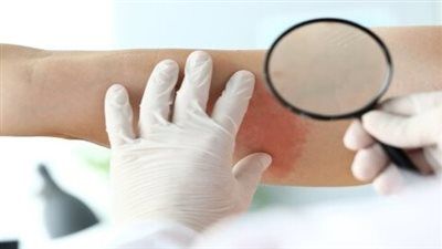 الحزام الناري.. طرق علاج حديثة توقف الألم وتمنع المضاعفات - الخليج الان