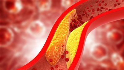 5 علامات تحذيرية تظهر خلال المشي قد تؤشر إلي ارتفاع الكوليسترول - الخليج الان